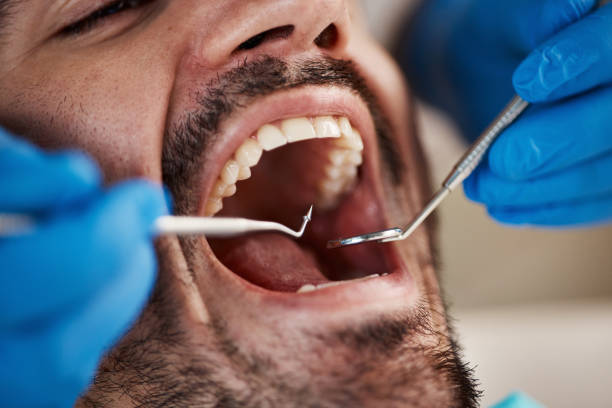 Best Knocked-Out Tooth (Avulsed Tooth) Treatment in Livonia, MI
